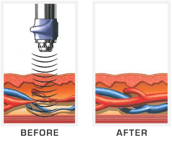 Physical Medicine Jacksonville FL GAINSWave Before & After